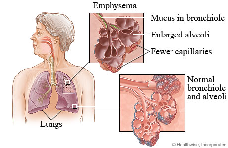 images of lungs with emphysema